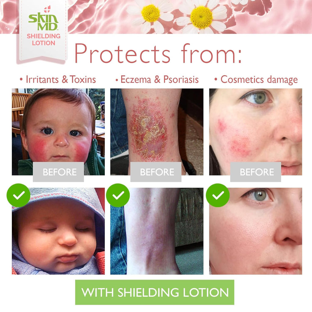 Skin MD Shielding Lotion - Hydrating Body Lotion for Sensitive Skin with Dispenser | Non-Greasy, Fast-Absorbing Moisturizer with Plant-Based Ingredients for Eczema & Psoriasis Relief - 8 oz Pump