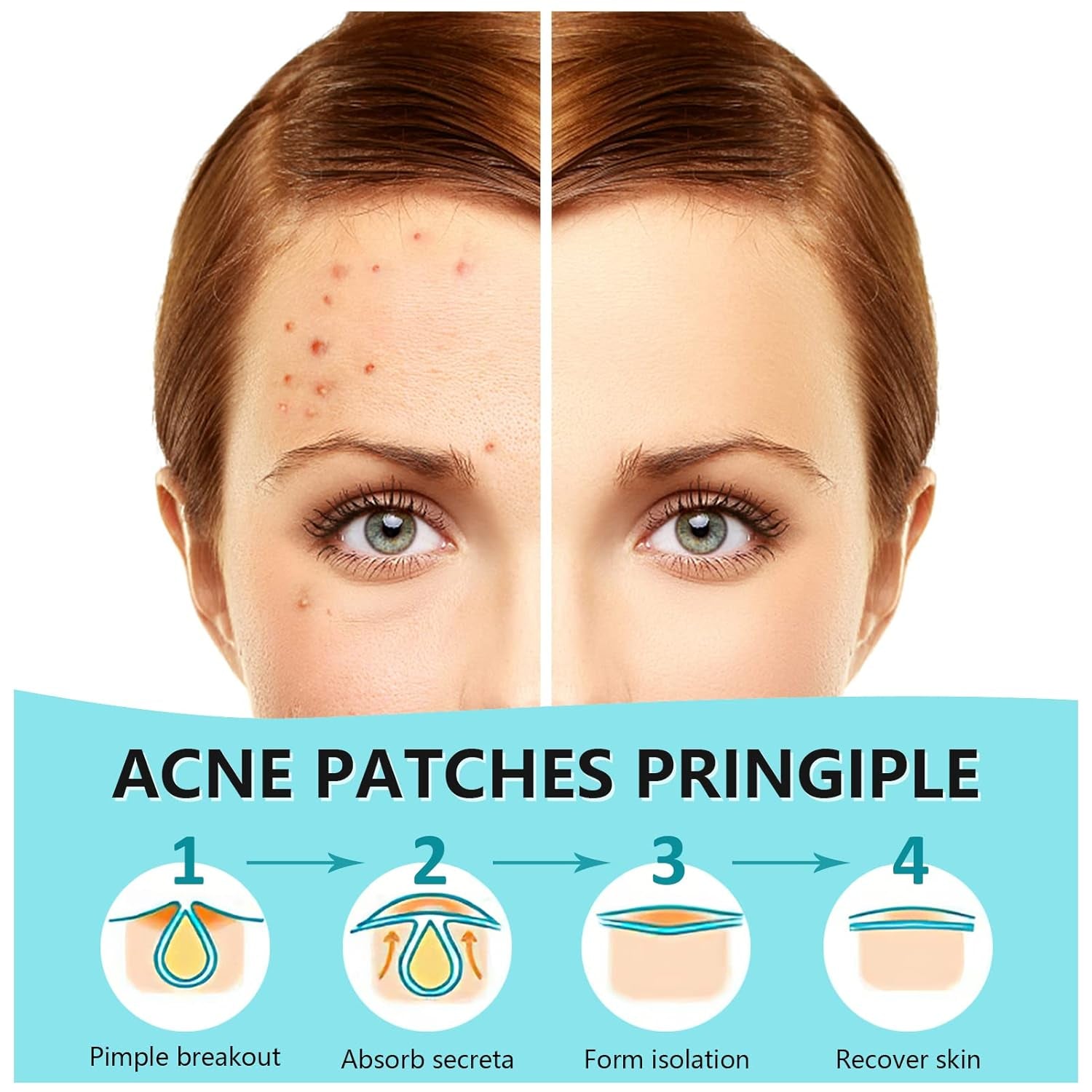 180 Count Hydrocolloid Acne Patches - Invisible Spot Treatment for Blemishes and Pimples